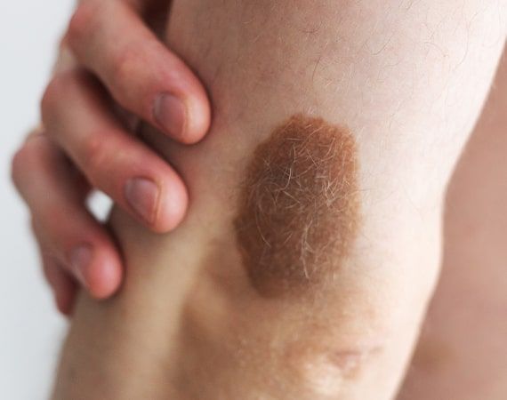 How Does Birthmark Removal Treatment Work?